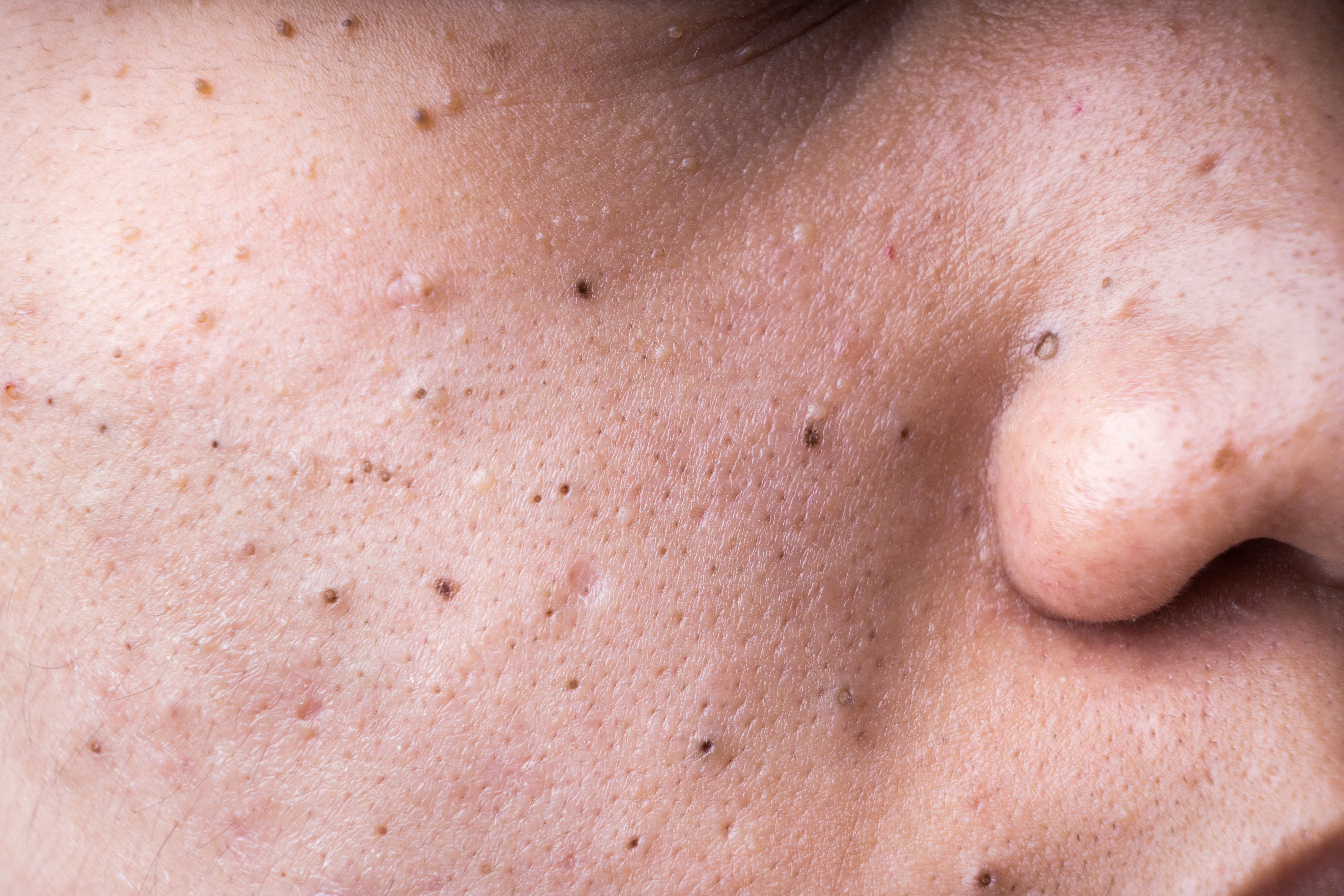 Huge Blackheads - fdzlzi6
