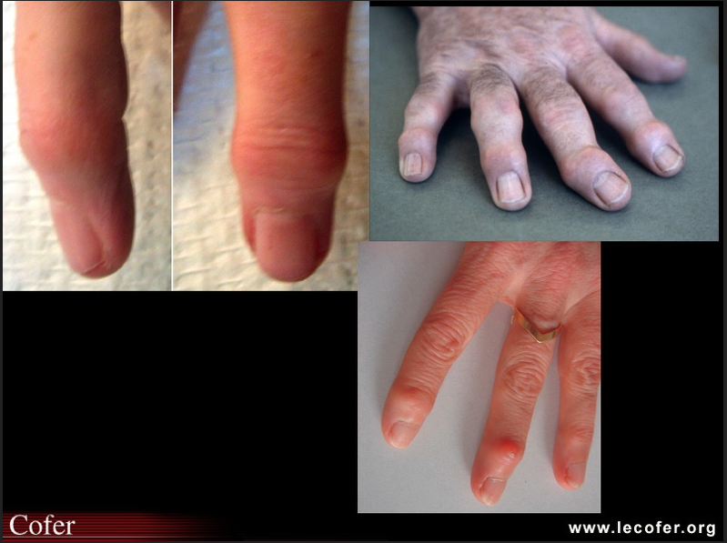 arthrose2