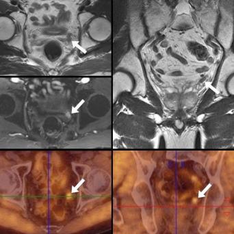 récidive de la tumeur de la prostate