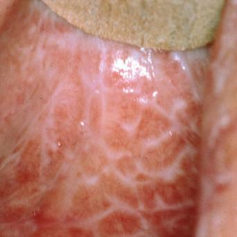 Réseau lichénien kératosique