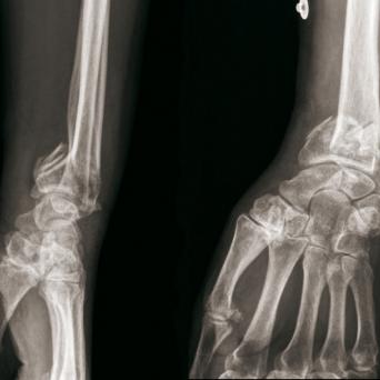 Fracture de Goyrand-Smith gauche