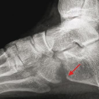 Arthrite tuberculeuse calcanéo-cuboïdienne