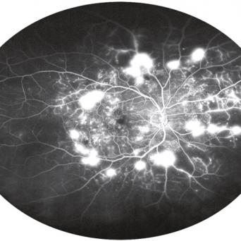 RETINOPATHIE DIABETIQUE