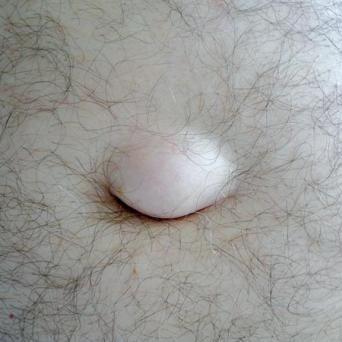 Hernie ombilicale