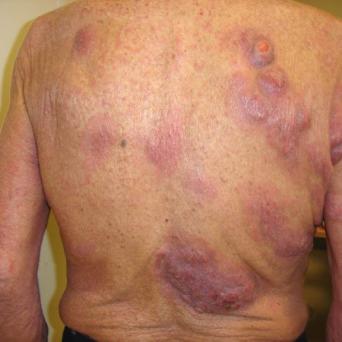 Lymphome T cutané : mycosis fongoïde