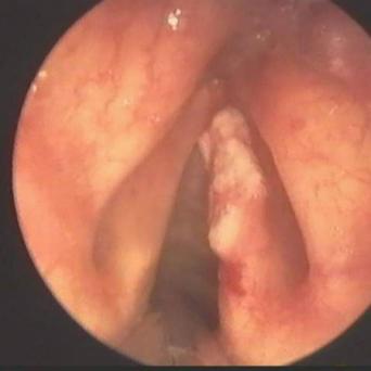 Carcinome épidermoïde de la corde vocale
