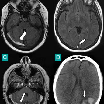 thrombose