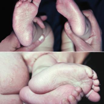 Metatarsus varus chez un nourrisson