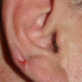 Chondrodermatite nodulaire chronique