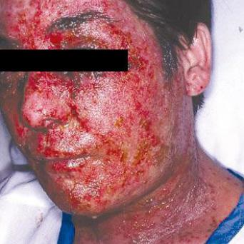 Syndrome de Kaposi-Juliusberg