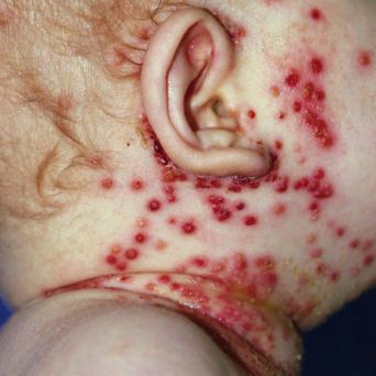 Eczema herpeticum