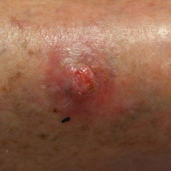 Mélanome achromique