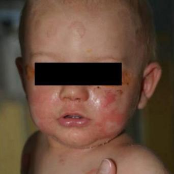 Epidermolyse staphylococcique