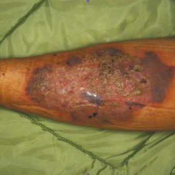 Pyoderma gangrenosum 