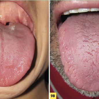 psoriasis de la langue