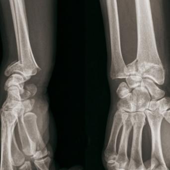 Fracture articulaire en T sagittale droite