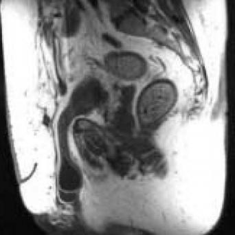 Hernie iguino-scrotale irréductible non étranglée.