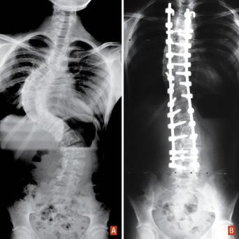 Traitement chirurgical d’une scoliose