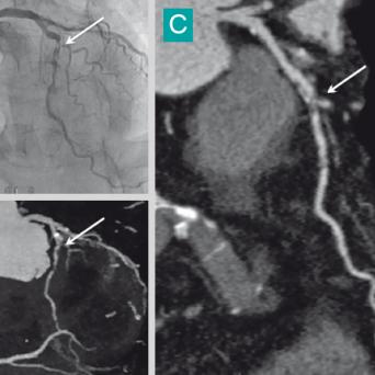 scanner cardiaque