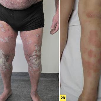 Psoriasis