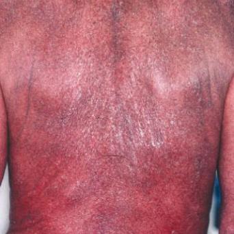 Lymphome T cutané : syndrome de Sézary