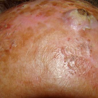 Carcinome épidermoïde invasif sur kératose actinique