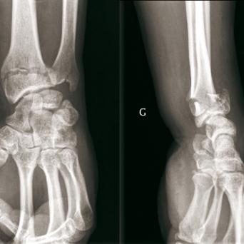 FRACTURES DU RADIUS