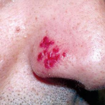 herpes narinaire - © Saskia Ingen-Housz-Oro (La Revue du Praticien)