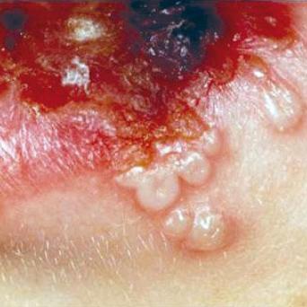 herpes