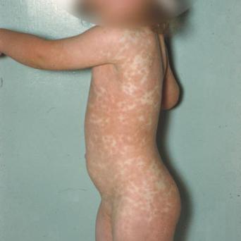 erythème infectieux