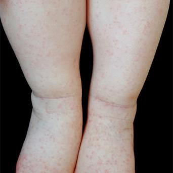 Éruption morbilliforme