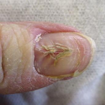 Dystrophie canaliforme de Heller