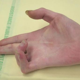 maladie-de-dupuytren