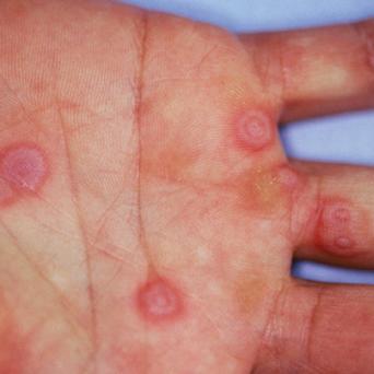 Erythème polymorphe dû à l'herpès