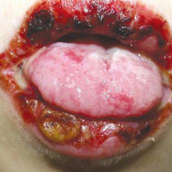 Erythème polymorphe post-herpétique