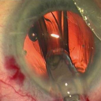EXTRACTION DE CATARACTE