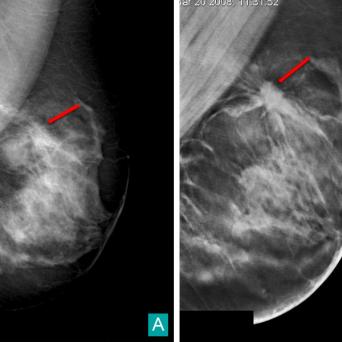 Tumeurs du sein - Lésion BI-RADS 2 maligne