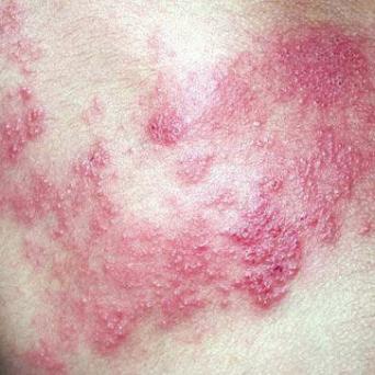 Zona thoracique gauche