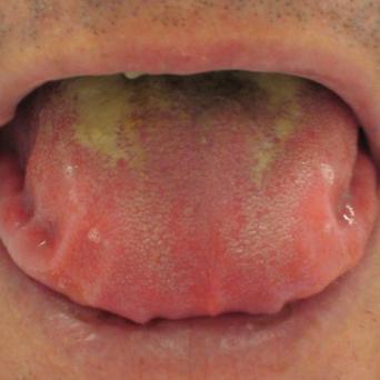 Macroglossie avec empreinte des dents sur la langue.