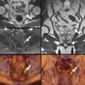 récidive de la tumeur de la prostate