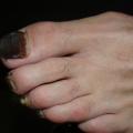 ongle