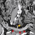 MALADIE DE CROHN