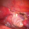 salpingectomie