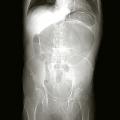 Volvulus 