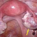 Endométriose kystique ovarienne ou endométriome