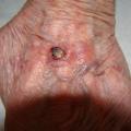 Carcinome épidermoïde ulcéro-végétant