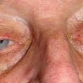 ptosis