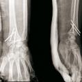 fracture radius