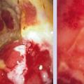 crohn
