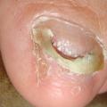 ONYCHOMADESE